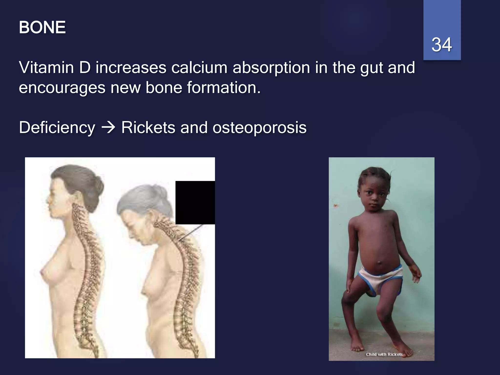 BONE
Vitamin D increases calcium absorption in the gut and
encourages new bone formation.
Deficiency  Rickets and osteoporosis
34
 