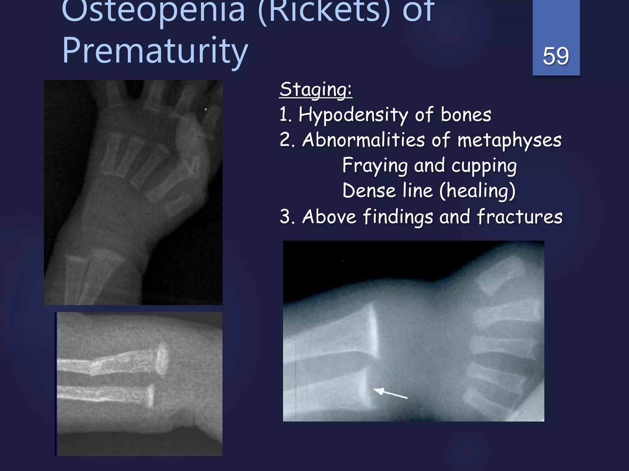 59
Osteopenia (Rickets) of
Prematurity
Staging:
1. Hypodensity of bones
2. Abnormalities of metaphyses
Fraying and cupping
Dense line (healing)
3. Above findings and fractures
 