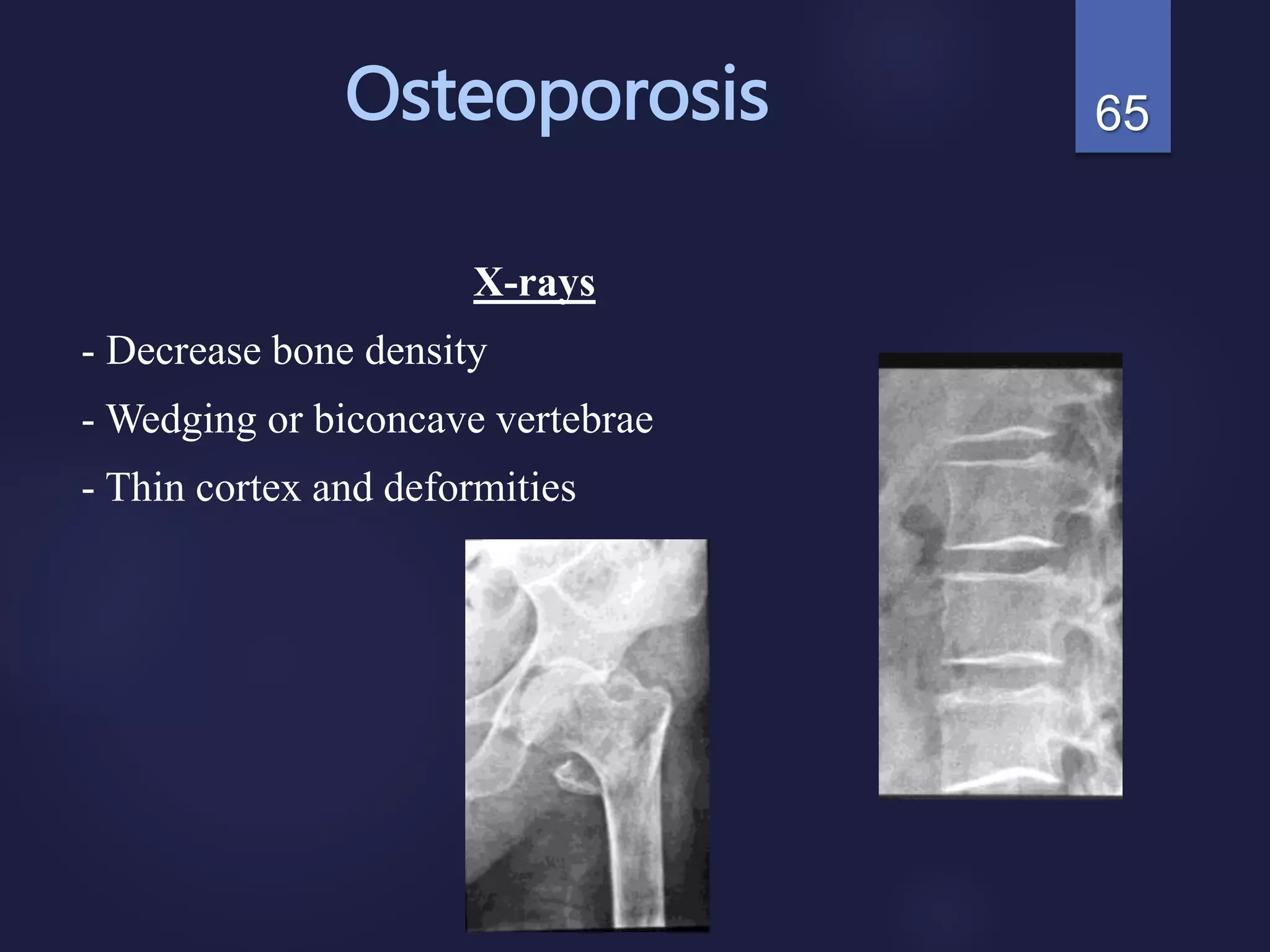 Osteoporosis
X-rays
- Decrease bone density
- Wedging or biconcave vertebrae
- Thin cortex and deformities
65
 
