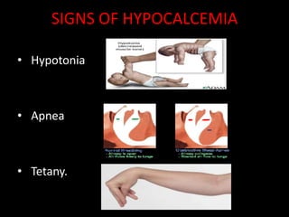 SIGNS OF HYPOCALCEMIA

• Hypotonia



• Apnea



• Tetany.
 
