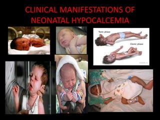 CLINICAL MANIFESTATIONS OF
 NEONATAL HYPOCALCEMIA
 