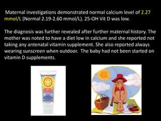 Maternal investigations demonstrated normal calcium level of 2.27
mmol/L (Normal 2.19-2.60 mmol/L). 25-OH Vit D was low.

The diagnosis was further revealed after further maternal history. The
mother was noted to have a diet low in calcium and she reported not
taking any antenatal vitamin supplement. She also reported always
wearing sunscreen when outdoor. The baby had not been started on
vitamin D supplements.
 