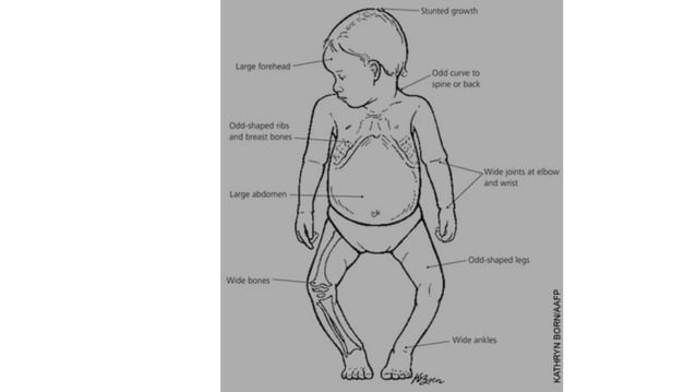 Vitamin d deficiency & rickets | PPT