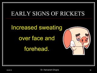 EARLY SIGNS OF RICKETS
Increased sweating
over face and
forehead.
05/29/18 Dr. Harivansh Chopra 38
 