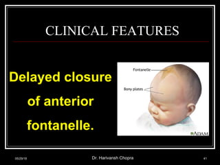CLINICAL FEATURES
Delayed closure
of anterior
fontanelle.
05/29/18 Dr. Harivansh Chopra 41
 