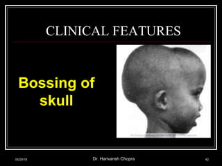 CLINICAL FEATURES
Bossing of
skull
05/29/18 Dr. Harivansh Chopra 42
 