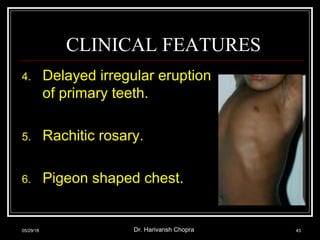 CLINICAL FEATURES
4. Delayed irregular eruption
of primary teeth.
5. Rachitic rosary.
6. Pigeon shaped chest.
05/29/18 Dr. Harivansh Chopra 43
 