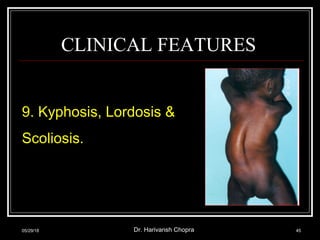CLINICAL FEATURES
9. Kyphosis, Lordosis &
Scoliosis.
05/29/18 Dr. Harivansh Chopra 45
 