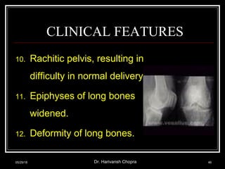 CLINICAL FEATURES
10. Rachitic pelvis, resulting in
difficulty in normal delivery.
11. Epiphyses of long bones
widened.
12. Deformity of long bones.
05/29/18 Dr. Harivansh Chopra 46
 