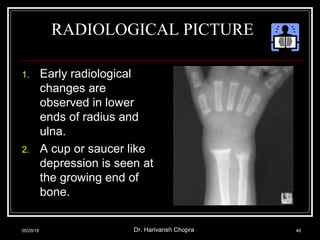RADIOLOGICAL PICTURE
1. Early radiological
changes are
observed in lower
ends of radius and
ulna.
2. A cup or saucer like
depression is seen at
the growing end of
bone.
05/29/18 Dr. Harivansh Chopra 49
 