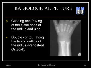 RADIOLOGICAL PICTURE
3. Cupping and fraying
of the distal ends of
the radius and ulna.
4. Double contour along
the lateral outline of
the radius (Periosteal
Osteoid).
05/29/18 Dr. Harivansh Chopra 50
 