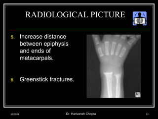 RADIOLOGICAL PICTURE
5. Increase distance
between epiphysis
and ends of
metacarpals.
6. Greenstick fractures.
05/29/18 Dr. Harivansh Chopra 51
 