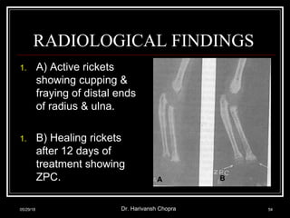 RADIOLOGICAL FINDINGS
1. A) Active rickets
showing cupping &
fraying of distal ends
of radius & ulna.
1. B) Healing rickets
after 12 days of
treatment showing
ZPC.
05/29/18 Dr. Harivansh Chopra 54
A B
 