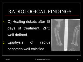 RADIOLOGICAL FINDINGS
05/29/18 Dr. Harivansh Chopra 55
1. C) Healing rickets after 18
days of treatment, ZPC
well defined.
2. Epiphysis of radius
becomes well calcified. C D
 