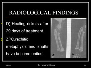RADIOLOGICAL FINDINGS
05/29/18 Dr. Harivansh Chopra 56
1. D) Healing rickets after
29 days of treatment.
2. ZPC,rachitic
metaphysis and shafts
have become united. C D
 