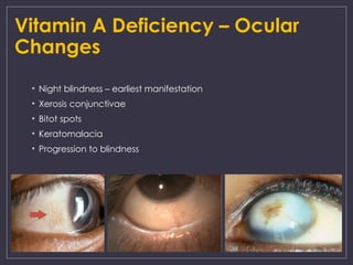Eye Deficiency Vitamin Deficiency- Vitamin A, C, D (MBBS) | PPTX