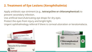 2. Treatment of Eye Lesions (Xerophthalmia)
Apply antibiotic eye ointment (e.g., tetracycline or chloramphenicol) to
prevent secondary infection.
Use artificial tears/lubricating eye drops for dry eyes.
Protect the eyes from injury and bright light.
Urgent ophthalmology referral if there is corneal ulceration or keratomalacia.
 