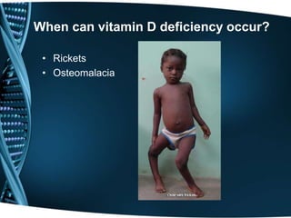 When can vitamin D deficiency occur?
• Rickets
• Osteomalacia
 
