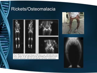 Rickets/Osteomalacia
 