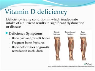 Vitamin D deficiency
Deficiency Symptoms
․ Bone pain and/or soft bones
․ Frequent bone fractures
․ Bone deformities or growth
retardation in children
http://health.allrefer.com/health/fracture-bone-fracture-repair-series.html
Deficiency is any condition in which inadequate
intake of a nutrient results in significant dysfunction
or disease
 