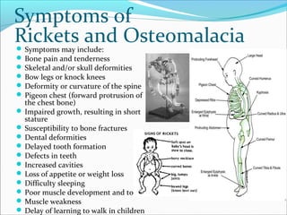 Symptoms of
Rickets and Osteomalacia Symptoms may include:
 Bone pain and tenderness
 Skeletal and/or skull deformities
 Bow legs or knock knees
 Deformity or curvature of the spine
 Pigeon chest (forward protrusion of
the chest bone)
 Impaired growth, resulting in short
stature
 Susceptibility to bone fractures
 Dental deformities
 Delayed tooth formation
 Defects in teeth
 Increased cavities
 Loss of appetite or weight loss
 Difficulty sleeping
 Poor muscle development and tone
 Muscle weakness
 Delay of learning to walk in children
 
