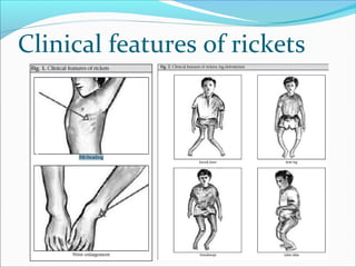 Clinical features of rickets
 