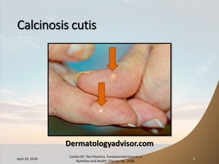 Calcinosis cutis
Dermatologyadvisor.com
April 10, 2018
Combs GF. The Vitamins. Fundamental Aspects in
Nutrition and Health. Elsevier Inc. 2008.
6
 