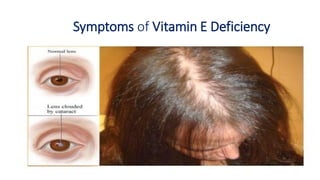 Symptoms of Vitamin E Deficiency
 