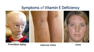 Symptoms of Vitamin E Deficiency
 