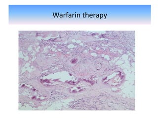 Warfarin therapy
 