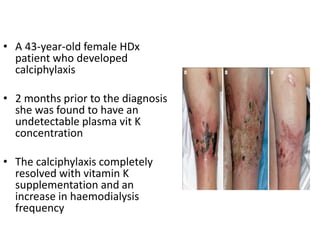 • A 43-year-old female HDx
patient who developed
calciphylaxis
• 2 months prior to the diagnosis
she was found to have an
undetectable plasma vit K
concentration
• The calciphylaxis completely
resolved with vitamin K
supplementation and an
increase in haemodialysis
frequency
 
