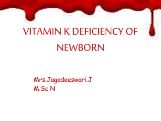 VITAMIN K DEFICIENCY OF
NEWBORN
Mrs.Jagadeeswari.J
M.Sc N
 