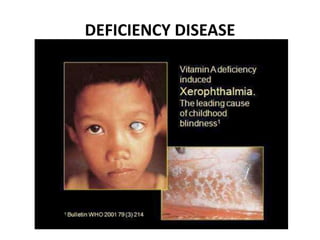 DEFICIENCY DISEASE 
 