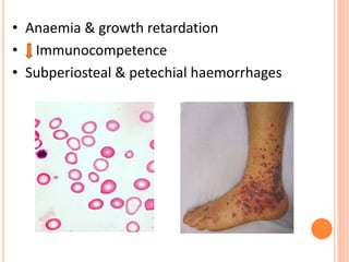 • Anaemia & growth retardation
• Immunocompetence
• Subperiosteal & petechial haemorrhages
 