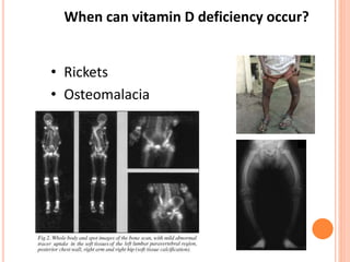 When can vitamin D deficiency occur?
• Rickets
• Osteomalacia
 