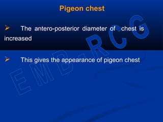 Pigeon chest
 The antero-posterior diameter of chest is
increased
 This gives the appearance of pigeon chest
 