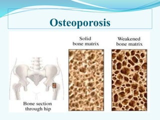 Osteoporosis
 