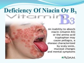 Deficiency Of Niacin Or B3
 