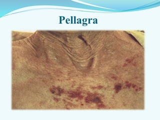 Pellagra
 