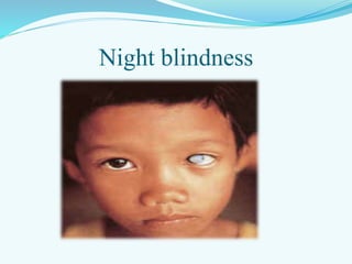 Night blindness
 