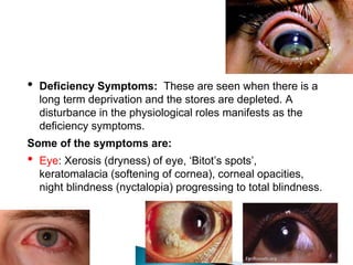 • Deficiency Symptoms: These are seen when there is a
long term deprivation and the stores are depleted. A
disturbance in the physiological roles manifests as the
deficiency symptoms.
Some of the symptoms are:
• Eye: Xerosis (dryness) of eye, ‘Bitot’s spots’,
keratomalacia (softening of cornea), corneal opacities,
night blindness (nyctalopia) progressing to total blindness.
 