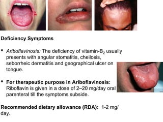 Deficiency Symptoms
• Ariboflavinosis: The deficiency of vitamin-B2 usually
presents with angular stomatitis, cheilosis,
seborrheic dermatitis and geographical ulcer on
tongue.
• For therapeutic purpose in Ariboflavinosis:
Riboflavin is given in a dose of 2–20 mg/day oral or
parenteral till the symptoms subside.
Recommended dietary allowance (RDA): 1-2 mg/
day.
 
