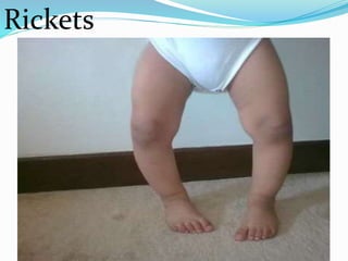 Rickets
 