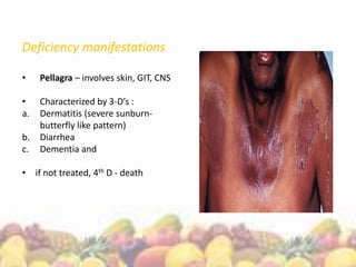 Deficiency manifestations
• Pellagra – involves skin, GIT, CNS
• Characterized by 3-D’s :
a. Dermatitis (severe sunburn-
butterfly like pattern)
b. Diarrhea
c. Dementia and
• if not treated, 4th D - death
 