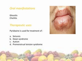 Oral manifestations
Glossitis
Cheilitis
Therapeutic uses
Pyridoxine is used for treatment of :
a. Seizures
b. Down syndrome
c. Autism
d. Premenstrual tension syndrome
 