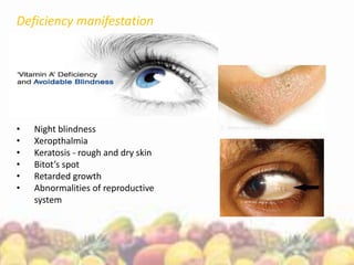 Deficiency manifestation
• Night blindness
• Xeropthalmia
• Keratosis - rough and dry skin
• Bitot’s spot
• Retarded growth
• Abnormalities of reproductive
system
 