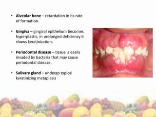 • Alveolar bone – retardation in its rate
of formation.
• Gingiva – gingival epithelium becomes
hyperplastic, in prolonged deficiency it
shows keratinization.
• Periodontal disease – tissue is easily
invaded by bacteria that may cause
periodontal disease.
• Salivary gland – undergo typical
keratinizing metaplasia
 