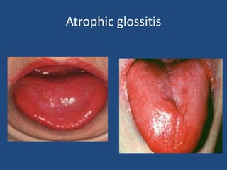 Atrophic glossitis
 