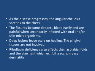 • As the disease progresses, the angular cheilosis
spreads to the cheek.
• The fissures become deeper , bleed easily and are
painful when secondarily infected with oral and/or
skin microorganisms.
• Deep lesions leave scars on healing. The gingival
tissues are not involved.
• Riboflavin deficiency also affects the nasolabial folds
and the alae nasi, which exhibit a scaly, greasy
dermatitis.
 