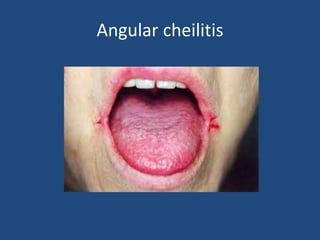 Angular cheilitis
 